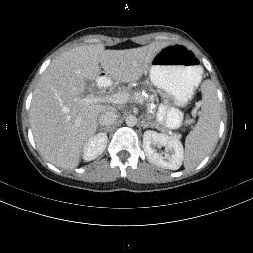 File:Chronic pancreatitis (Radiopaedia 64576-73450 C 36).jpg