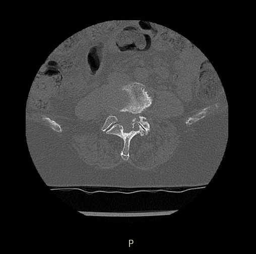 Chronic spinal hematoma with cauda equina syndrome (Radiopaedia 75745-88197 Axial bone window 41).png