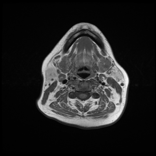 File:Chronic submandibular sialadenitis (Radiopaedia 61852-69885 Axial T1 15).jpg