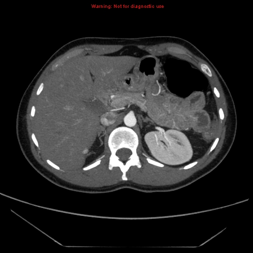 File:Circumaortic left renal vein (Radiopaedia 9069-9792 A 8).jpg