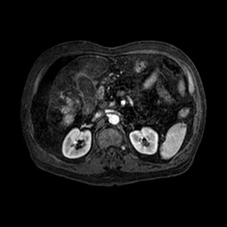 File:Cirrhosis and hepatocellular carcinoma in the setting of hemochromatosis (Radiopaedia 75394-86594 Axial T1 C+ fat sat 116).jpg