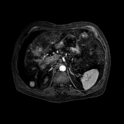 Cirrhosis and hepatocellular carcinoma in the setting of hemochromatosis (Radiopaedia 75394-86594 Axial T1 C+ fat sat 130).jpg