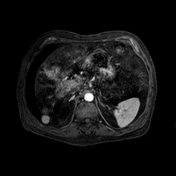 Cirrhosis and hepatocellular carcinoma in the setting of hemochromatosis (Radiopaedia 75394-86594 Axial T1 C+ fat sat 131).jpg