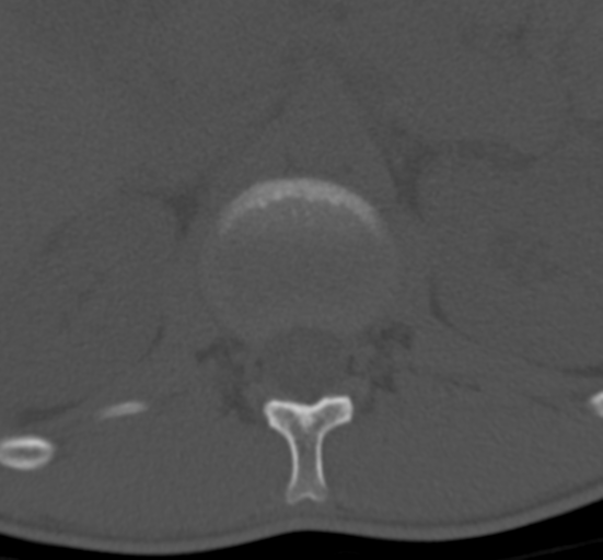 Clear cell meningoma - lumbar spine (Radiopaedia 60116-67691 Axial bone window 9).png