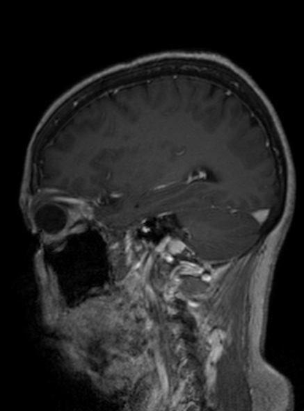 Clival meningioma (Radiopaedia 53278-59248 Sagittal T1 C+ 203).jpg