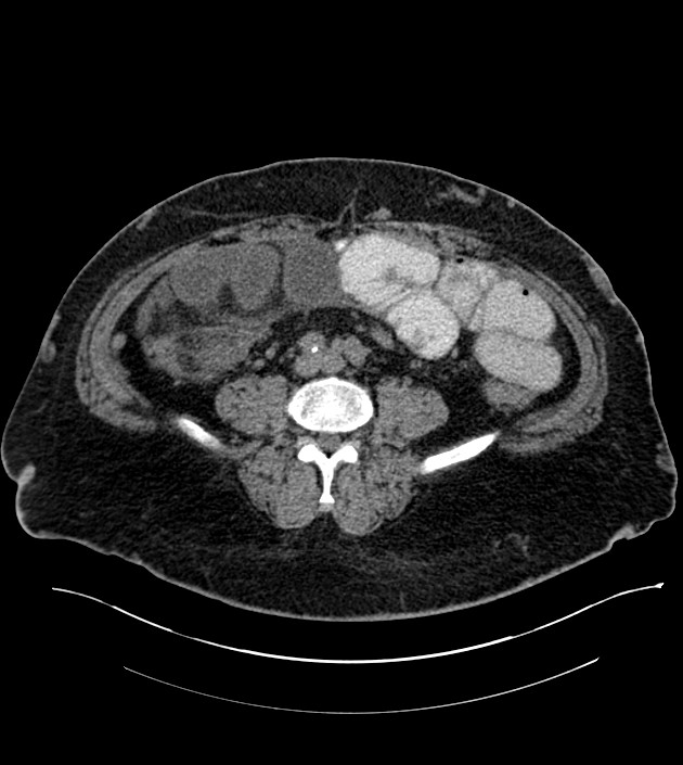 Closed-loop small bowel obstruction-internal hernia (Radiopaedia 78439-91096 Axial non-contrast 99).jpg