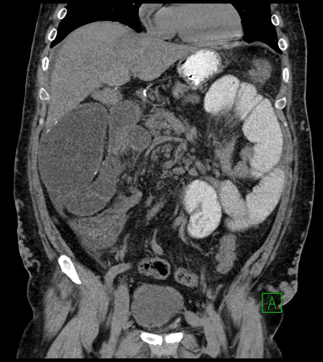 Closed-loop small bowel obstruction-internal hernia (Radiopaedia 78439-91096 Coronal non-contrast 44).jpg