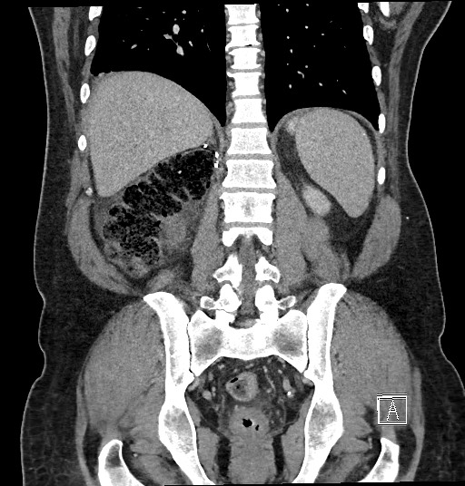 Closed loop obstruction - internal hernia into nephrectomy bed (Radiopaedia 59867-67320 B 101).jpg