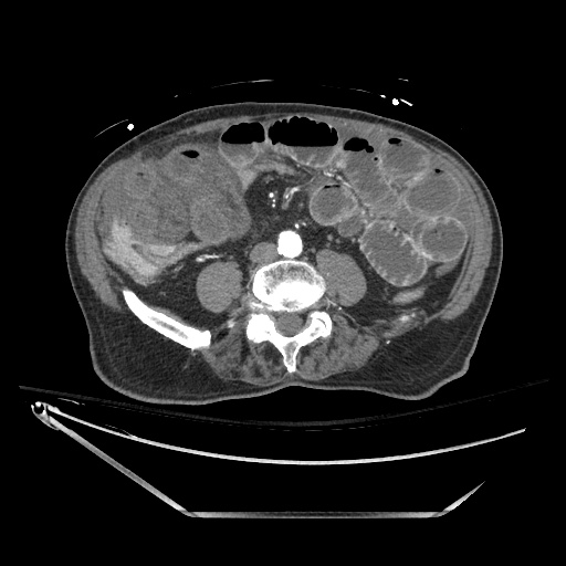 File:Closed loop obstruction due to adhesive band, resulting in small bowel ischemia and resection (Radiopaedia 83835-99023 Axial 205).jpg