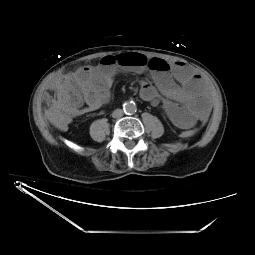 File:Closed loop obstruction due to adhesive band, resulting in small bowel ischemia and resection (Radiopaedia 83835-99023 Axial non-contrast 90).jpg