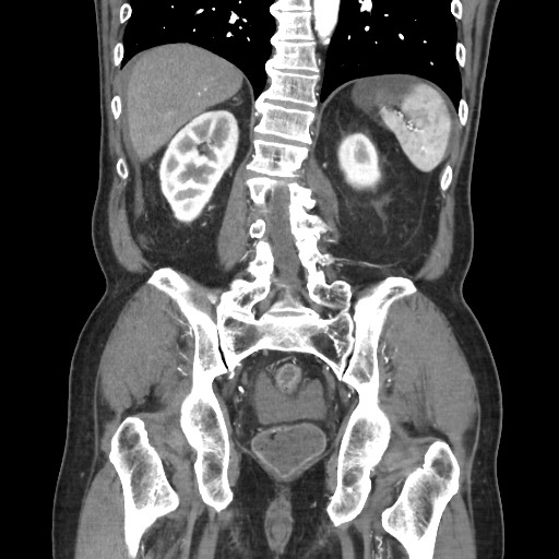 File:Closed loop obstruction due to adhesive band, resulting in small bowel ischemia and resection (Radiopaedia 83835-99023 C 89).jpg