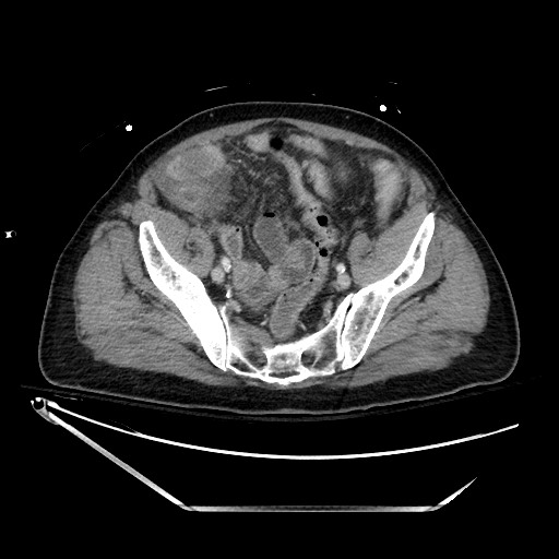 Closed loop obstruction due to adhesive band, resulting in small bowel ischemia and resection (Radiopaedia 83835-99023 D 124).jpg