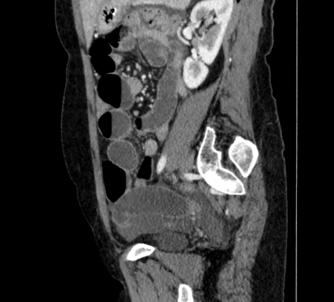 Closed loop small bowel obstruction (Radiopaedia 71211-81508 C 108).jpg