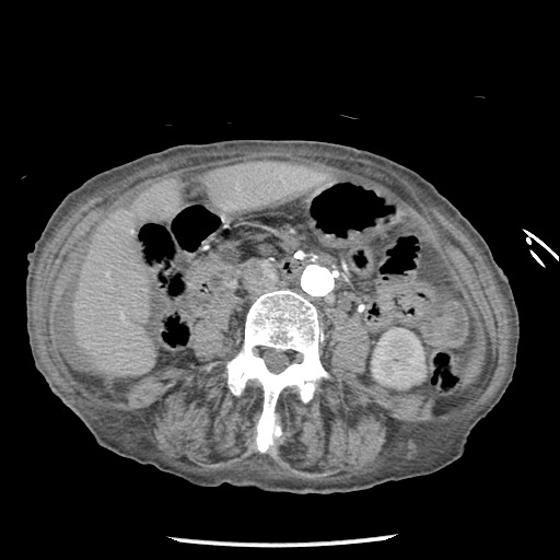 Closed loop small bowel obstruction - adhesions and infarct (Radiopaedia 85125-100678 A 88).jpg