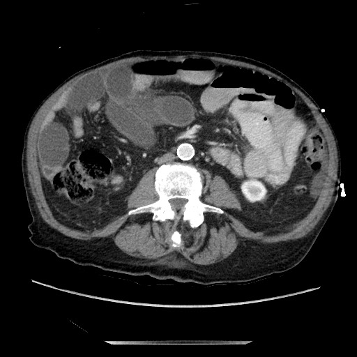 File:Closed loop small bowel obstruction - adhesive disease and hemorrhagic ischemia (Radiopaedia 86831-102990 A 103).jpg