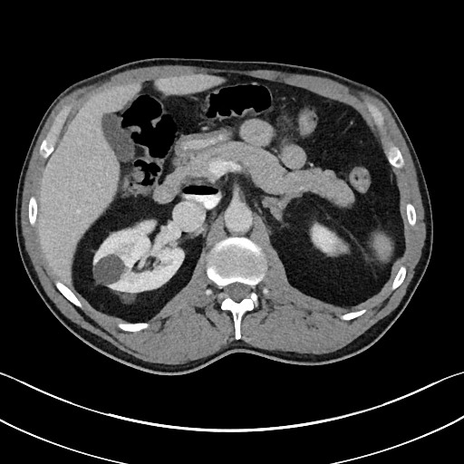 Closed loop small bowel obstruction - internal hernia (Radiopaedia 57806-64778 B 40).jpg