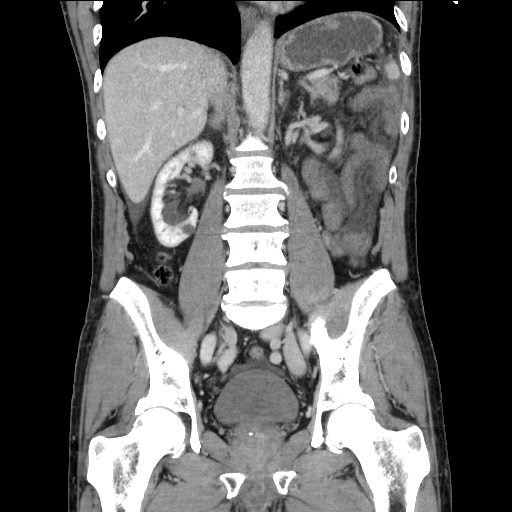 File:Closed loop small bowel obstruction - omental adhesion causing "internal hernia" (Radiopaedia 85129-100682 B 77).jpg