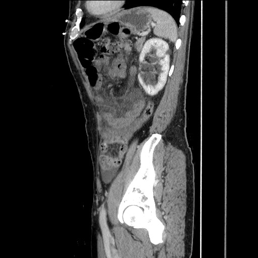 Closed loop small bowel obstruction - omental adhesion causing "internal hernia" (Radiopaedia 85129-100682 C 134).jpg