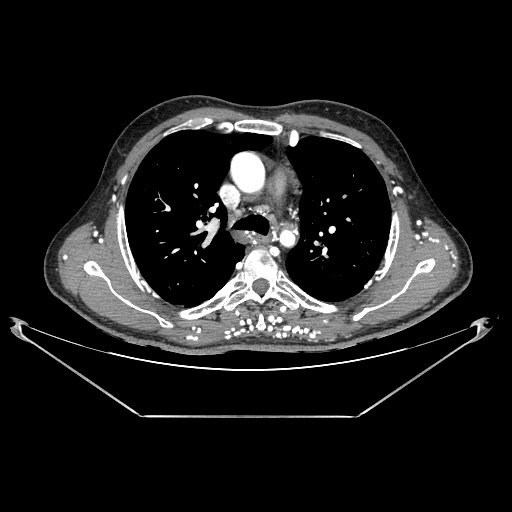 Coarctation of aorta (Radiopaedia 25384-25630 A 53).jpg