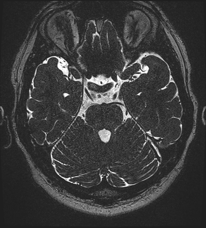 Cochlear incomplete partition type III associated with hypothalamic hamartoma (Radiopaedia 88756-105498 Axial T2 118).jpg