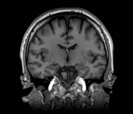 Cochlear incomplete partition type III associated with hypothalamic hamartoma (Radiopaedia 88756-105498 Coronal T1 34).jpg
