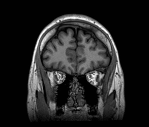 File:Cochlear incomplete partition type III associated with hypothalamic hamartoma (Radiopaedia 88756-105498 Coronal T1 50).jpg