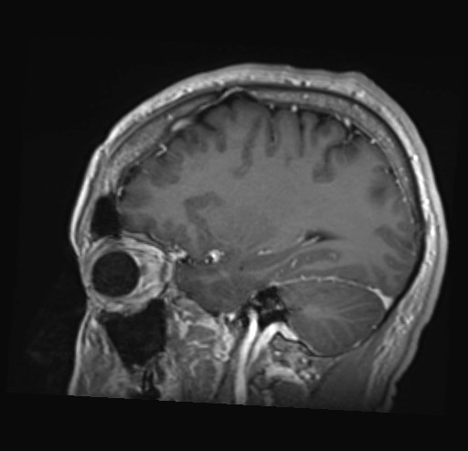 Cochlear incomplete partition type III associated with hypothalamic hamartoma (Radiopaedia 88756-105498 Sagittal T1 C+ 17).jpg