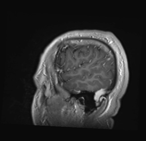 Cochlear incomplete partition type III associated with hypothalamic hamartoma (Radiopaedia 88756-105498 Sagittal T1 C+ 47).jpg