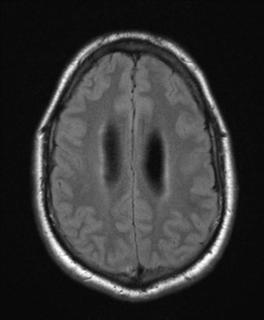 File:Colloid cyst (Radiopaedia 44510-48181 Axial FLAIR 21).png