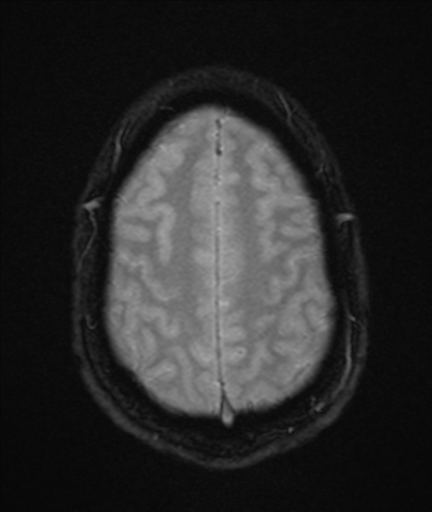 File:Colloid cyst (Radiopaedia 44510-48181 Axial Gradient Echo 22).png