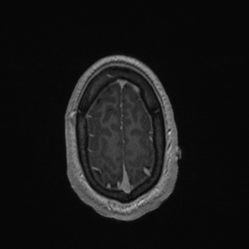 Colloid cyst (Radiopaedia 44510-48181 Axial T1 C+ 160).png