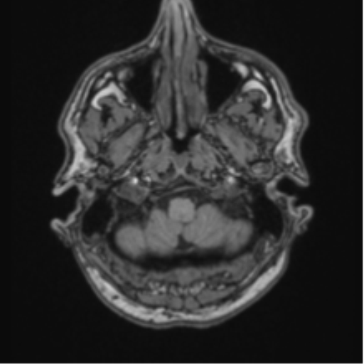 File:Colloid cyst of the third ventricle (Radiopaedia 86571-102662 Axial T1 13).png