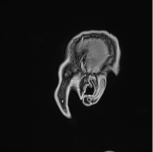 File:Colloid cyst of the third ventricle (Radiopaedia 86571-102662 Sagittal T1 C+ 4).png