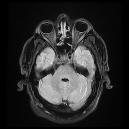 File:Colloid cyst with anterior communicating artery aneurysm (Radiopaedia 33901-35091 Axial FLAIR 6).jpg