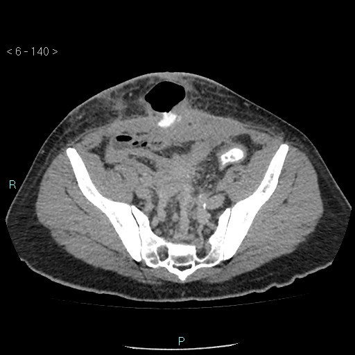 File:Colo-cutaneous fistula (Radiopaedia 40531-43129 A 58).jpg