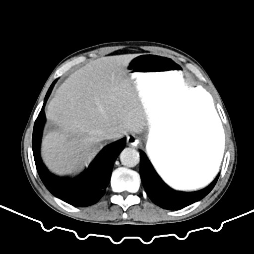 Colocolic intussusception due to large lipoma (Radiopaedia 68773-78482 A 17).jpg