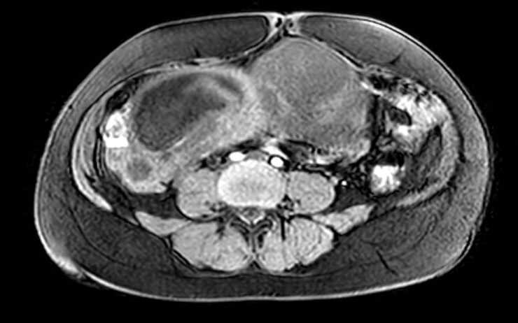 Colon adenocarcinoma with Krukenberg tumors, advanced pregnancy (Radiopaedia 67279-76645 A 36).jpg