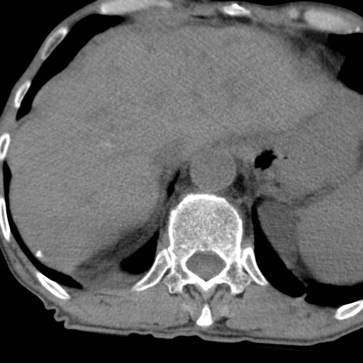 Colon cancer with calcified liver metastasis (Radiopaedia 74423-85309 Axial non-contrast 19).jpg