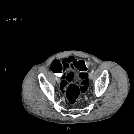 File:Colonic cancer (ultrasound and TC imaging) (Radiopaedia 50346-55713 A 120).jpg
