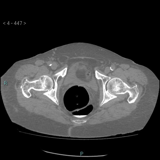 Colonic lipomas (Radiopaedia 49137-54244 Axial bone window 199).jpg