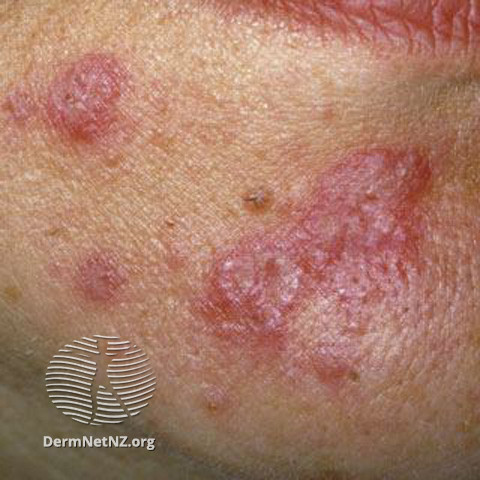 Cutaneous lupus erythematosus (DermNet NZ immune-lupus-erythematosus-2522).jpg