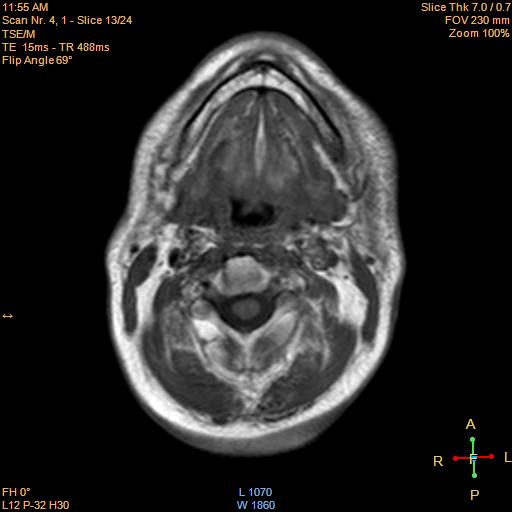 File:Nasopharyngeal carcinoma (Radiopaedia 22375-22403 Axial T1 11).jpg