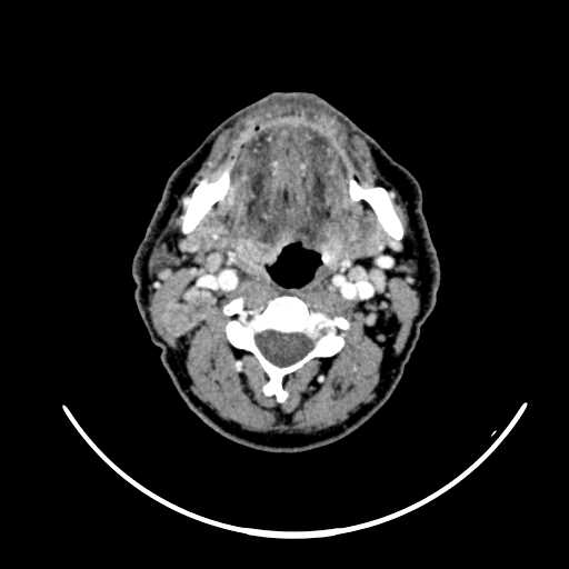 File:Nasopharyngeal carcinoma - infiltrating the clivus (Radiopaedia 62583-70875 Axial Post contrast 35).jpg