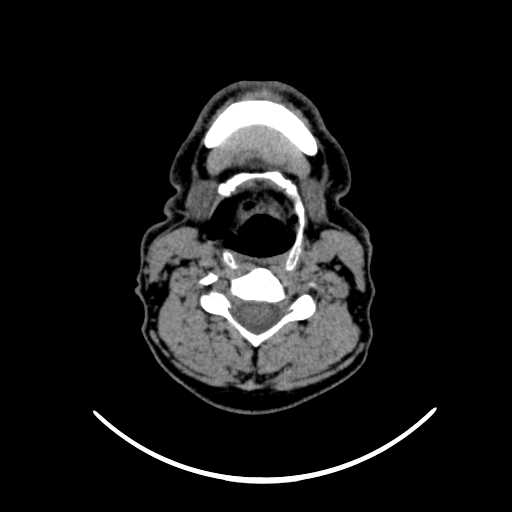 File:Nasopharyngeal carcinoma - infiltrating the clivus (Radiopaedia 62583-70875 Axial non-contrast 45).jpg