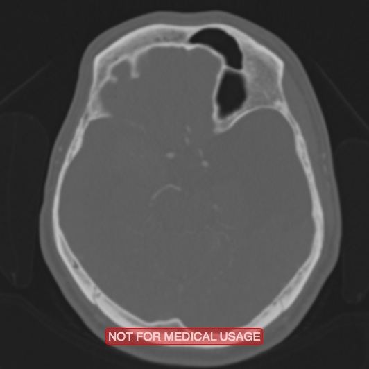Nasopharyngeal carcinoma recurrence - skull base destruction (Radiopaedia 29107-29490 Axial bone window 64).jpg