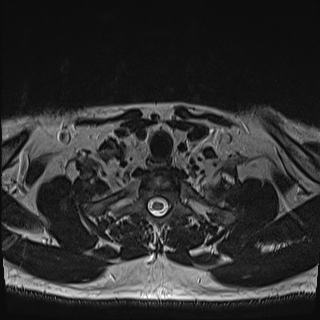 Nasopharyngeal carcinoma with perineural spread (Radiopaedia 55030-61380 Axial T2 81).jpg