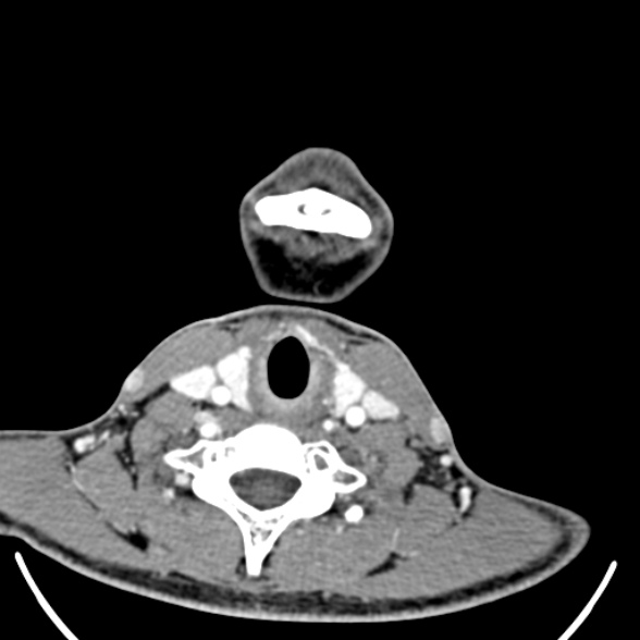 Nasopharyngeal carcinoma with skull base invasion (Radiopaedia 53415-59705 A 162).jpg