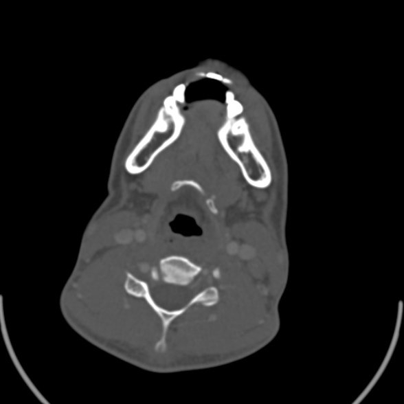 Nasopharyngeal carcinoma with skull base invasion (Radiopaedia 53415-59705 Axial bone window 131).jpg