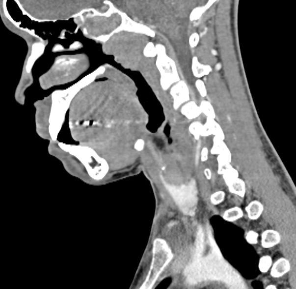 Nasopharyngeal carcinoma with skull base invasion (Radiopaedia 53415-59705 C 38).jpg