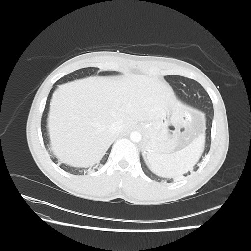 Near-drowning pulmonary edema (Radiopaedia 59457-66814 Axial lung window 50).jpg